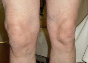 Преди да използва Osteflex, коленете на Нилс бяха подути до края на деня.